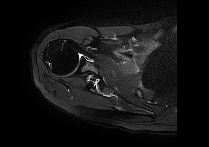 下関みよし鍼灸整骨院で見つかった肩関節脱臼のMRI